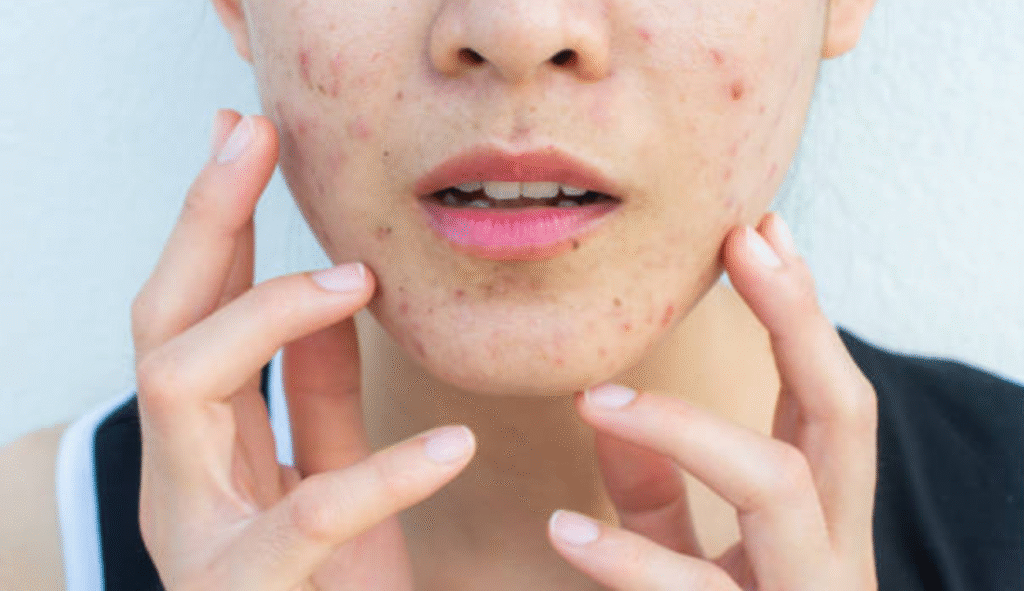 acne around mouth