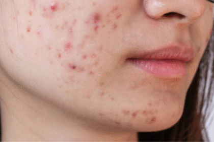 Acne Around Mouth