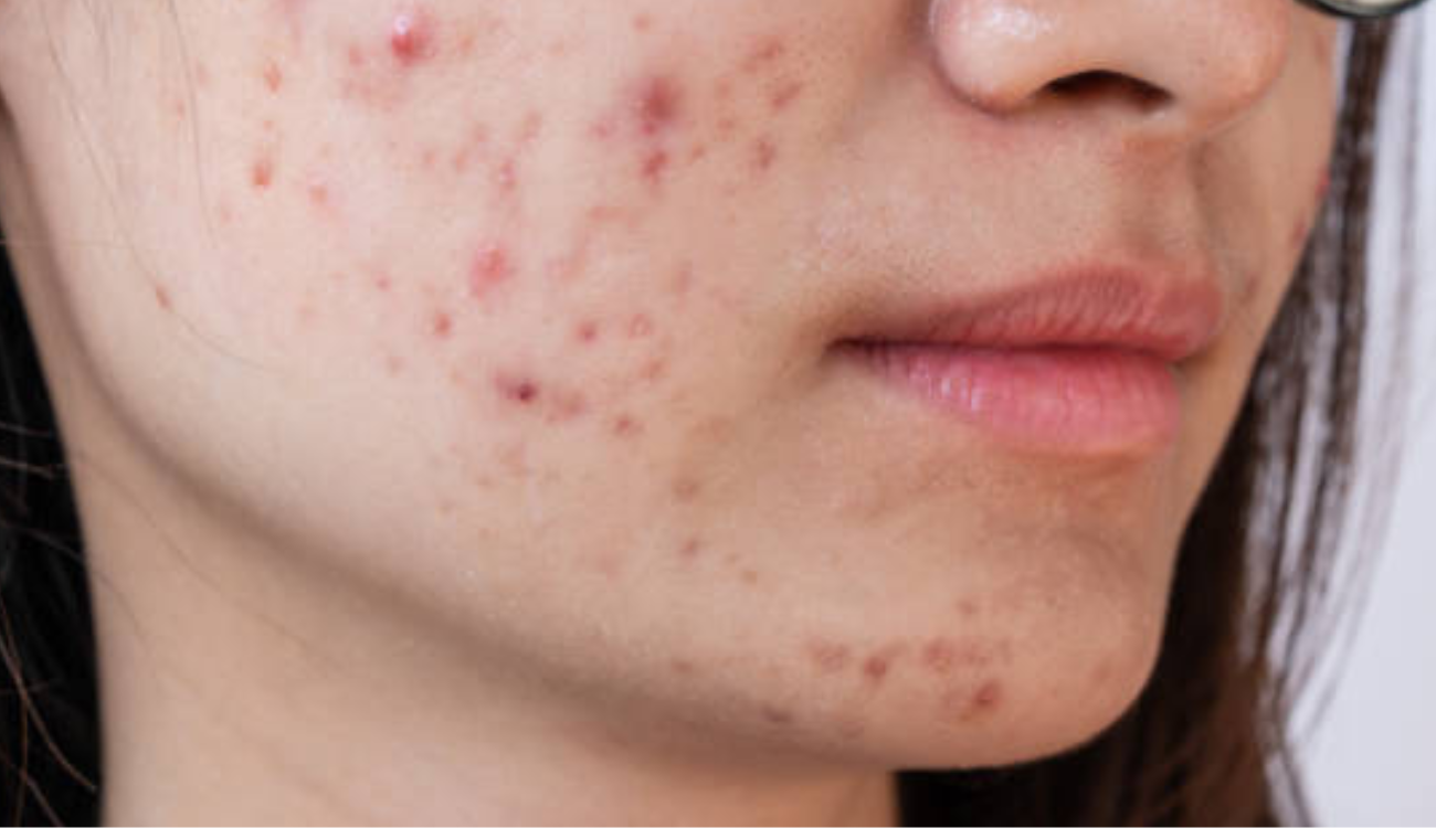 Acne Around Mouth